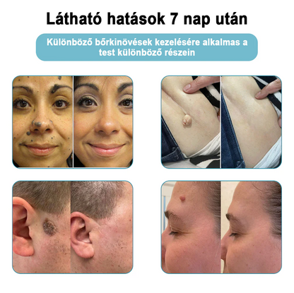 ✨ Bikenda®  – Laserowy Długopis CO₂ do Usuwania 🟤 Znamion, 🦠 Brodawek, 🔘 Przebarwień i Innych Niedoskonałości Skóry）☪️