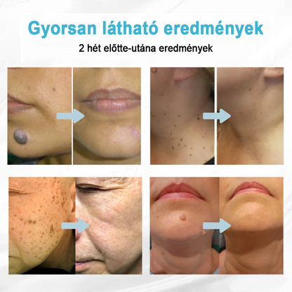 ✨ Bikenda®  – Laserowy Długopis CO₂ do Usuwania 🟤 Znamion, 🦠 Brodawek, 🔘 Przebarwień i Innych Niedoskonałości Skóry）☪️