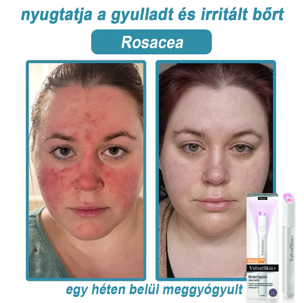 ✨ Bikenda®  – Laserowy Długopis CO₂ do Usuwania 🟤 Znamion, 🦠 Brodawek, 🔘 Przebarwień i Innych Niedoskonałości Skóry）☪️
