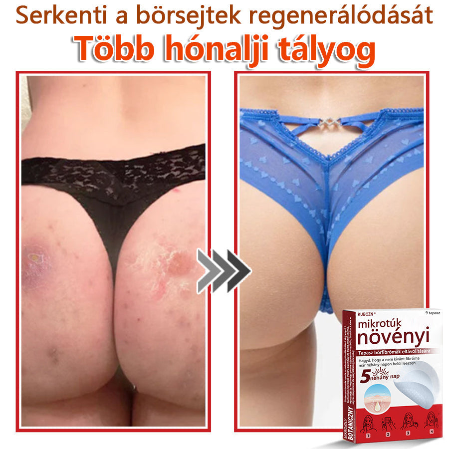 ✅KUBOZN® Mikrotűs Botanikus Bőrkinövés Eltávolító Tapaszok | Magyarországon készült  🛒