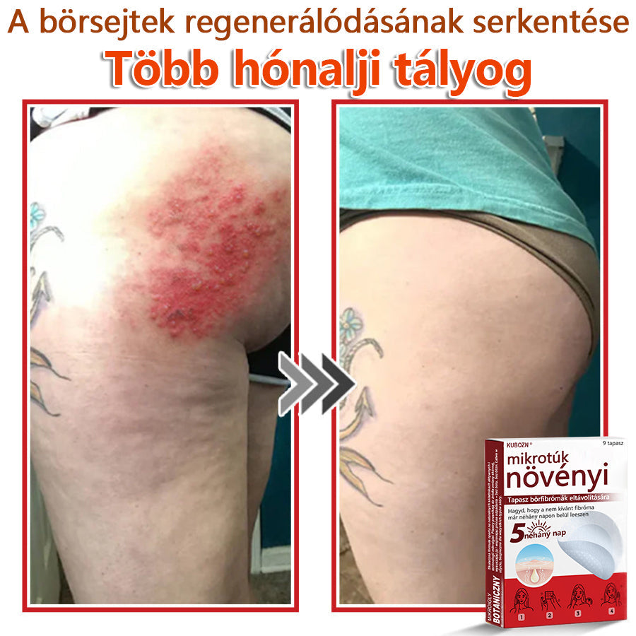 ✅KUBOZN® Mikrotűs Botanikus Bőrkinövés Eltávolító Tapaszok | Magyarországon készült  🛒
