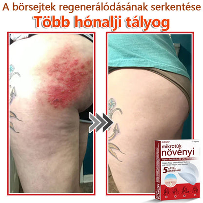 ✅KUBOZN® Mikrotűs Botanikus Bőrkinövés Eltávolító Tapaszok | Magyarországon készült  🛒