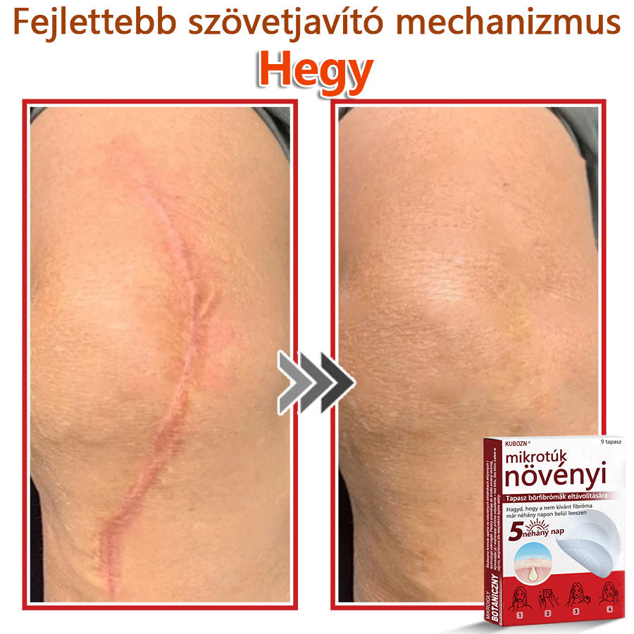 ✅KUBOZN® Mikrotűs Botanikus Bőrkinövés Eltávolító Tapaszok | Magyarországon készült  🛒