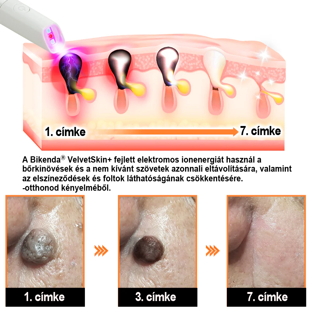 ✨ Bikenda®  – Laserowy Długopis CO₂ do Usuwania 🟤 Znamion, 🦠 Brodawek, 🔘 Przebarwień i Innych Niedoskonałości Skóry）☪️