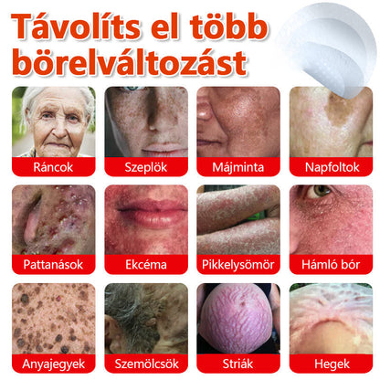 ✅KUBOZN® Mikrotűs Botanikus Bőrkinövés Eltávolító Tapaszok | Magyarországon készült  🛒
