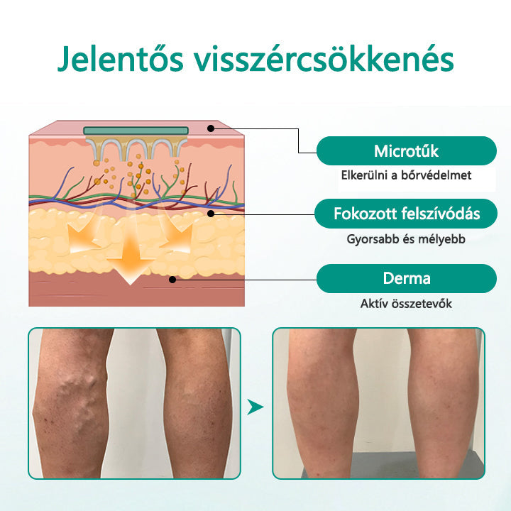 ✅✅Timilk® LegRenew Visszér Tapasz