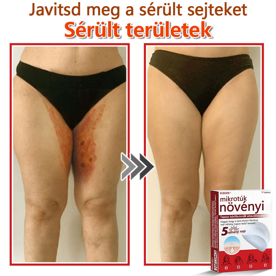 ✅KUBOZN® Mikrotűs Botanikus Bőrkinövés Eltávolító Tapaszok | Magyarországon készült  🛒