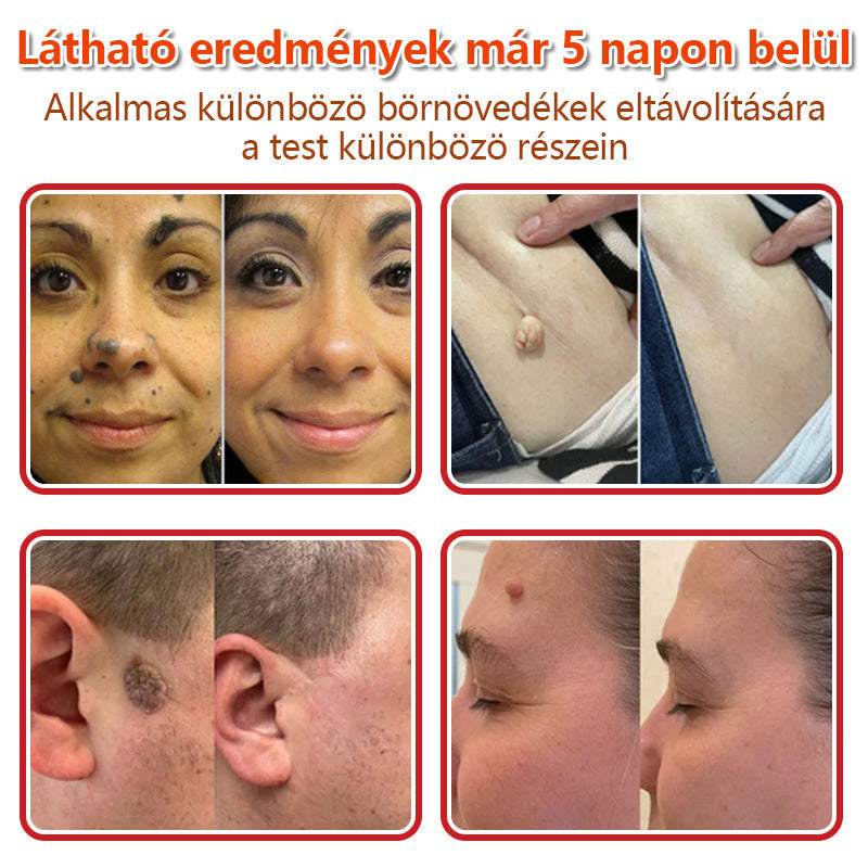 ✅KUBOZN® Mikrotűs Botanikus Bőrkinövés Eltávolító Tapaszok | Magyarországon készült  🛒