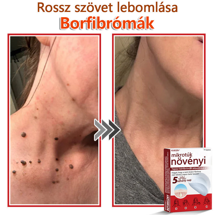 ✅KUBOZN® Mikrotűs Botanikus Bőrkinövés Eltávolító Tapaszok | Magyarországon készült  🛒