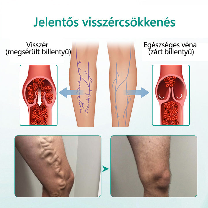 ✅✅Timilk® LegRenew Visszér Tapasz