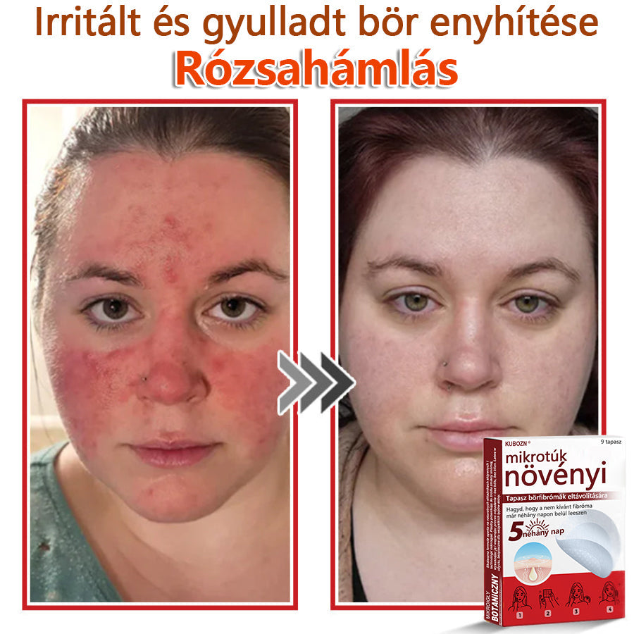 ✅KUBOZN® Mikrotűs Botanikus Bőrkinövés Eltávolító Tapaszok | Magyarországon készült  🛒