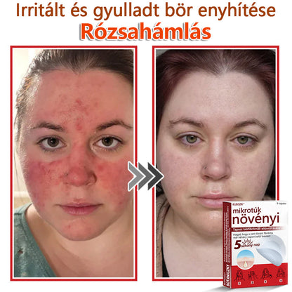 ✅KUBOZN® Mikrotűs Botanikus Bőrkinövés Eltávolító Tapaszok | Magyarországon készült  🛒