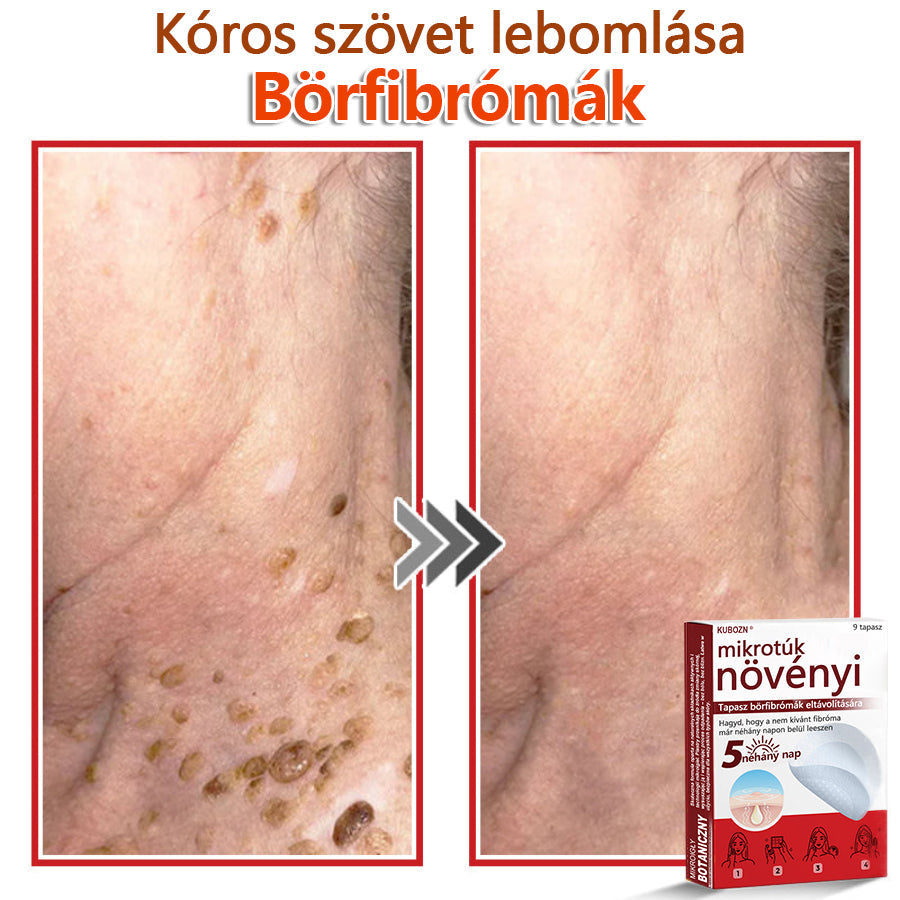 ✅KUBOZN® Mikrotűs Botanikus Bőrkinövés Eltávolító Tapaszok | Magyarországon készült  🛒