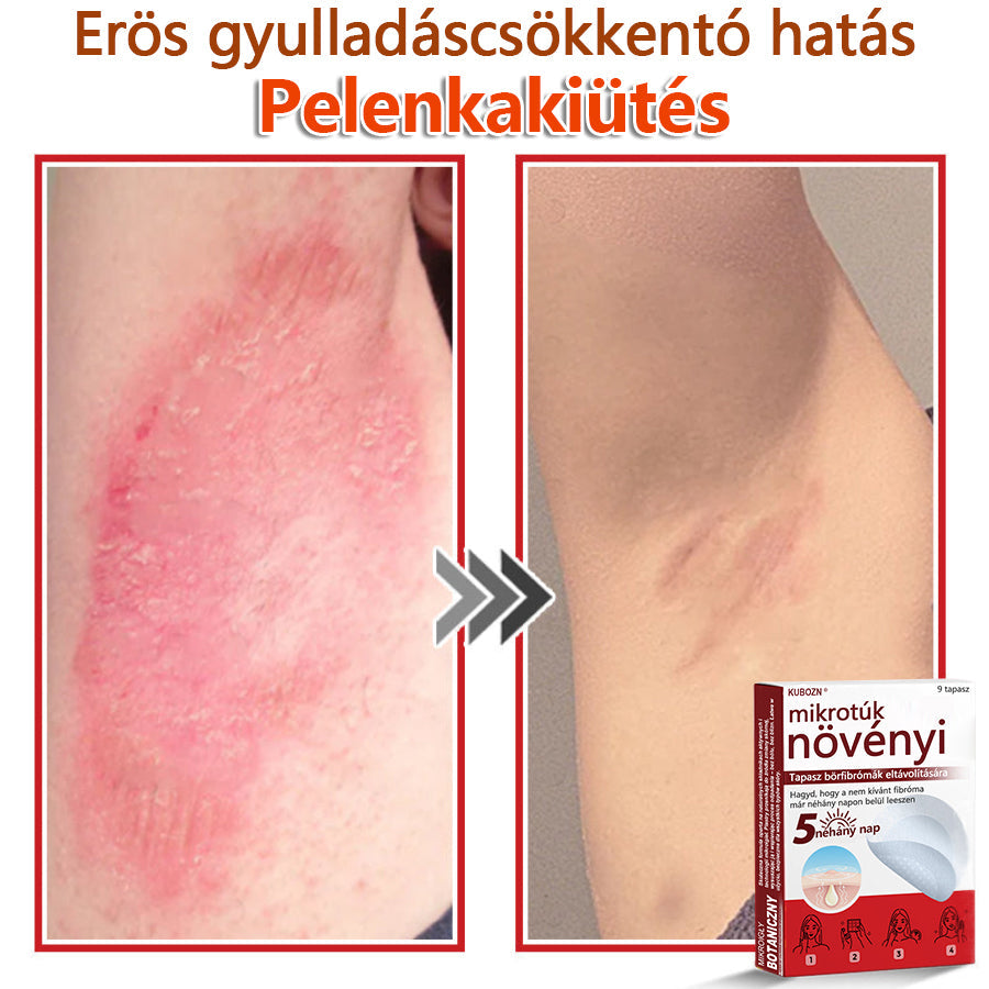 ✅KUBOZN® Mikrotűs Botanikus Bőrkinövés Eltávolító Tapaszok | Magyarországon készült  🛒